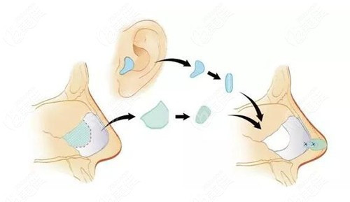 耳软骨隆鼻手术流程图