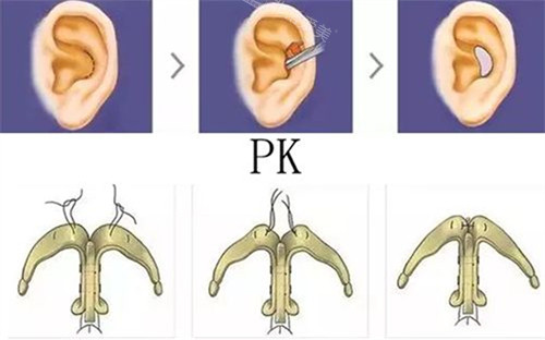 耳軟骨隆鼻手術示意圖