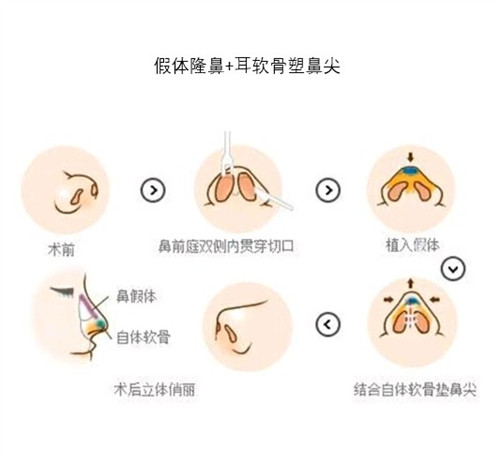 假體隆鼻和耳軟骨隆鼻示意圖 假體隆鼻和耳軟骨隆鼻示意圖