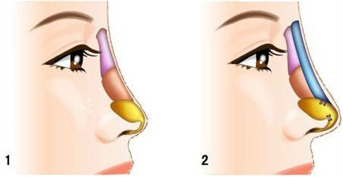 假体隆鼻示意图