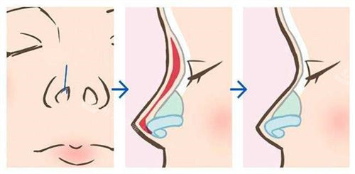 硅胶隆鼻手术流程示意图