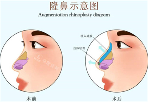 隆鼻示意图
