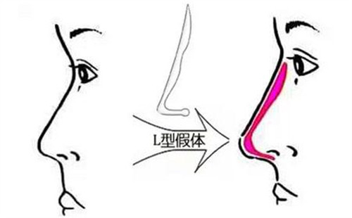 填充假體后對比圖