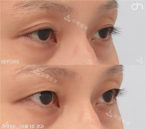 韩国喜可整形外科双眼皮改单眼皮手术对比照
