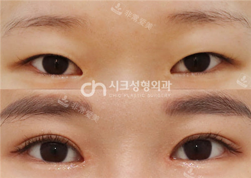 韩国喜可整形外科双眼皮手术对比照