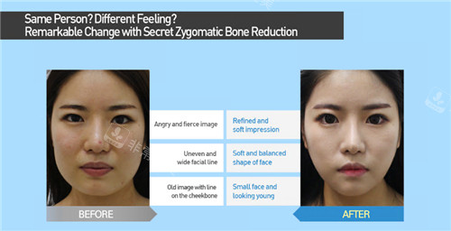 韩国那木整形医院面部轮廓整形对比照
