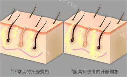 腋臭患者汗腺展示图