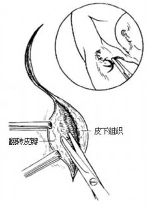 腋臭手术图