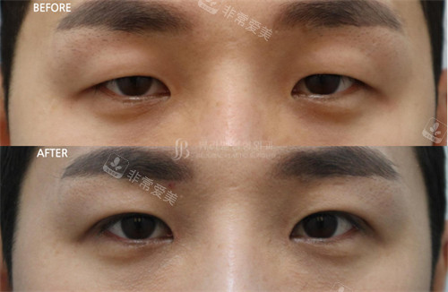 韩国Beulibal整形外科自然粘连双眼皮术前术后对比图