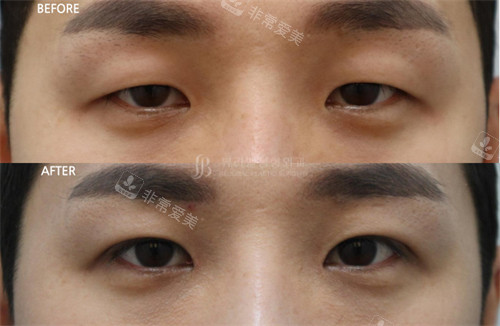 韓國(guó)Beulibal整形外科自然粘連雙眼皮術(shù)前術(shù)后對(duì)比圖