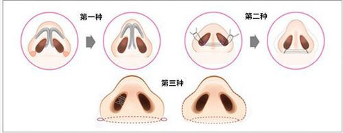 鼻翼缩小手术流程图