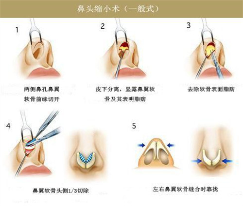 鼻頭縮小術(shù)示意圖