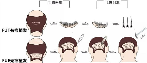 FUE和FUT植發(fā)圖