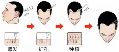 FUE植发和FUT植发有什么区别？揭秘两者不同之处！