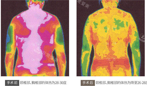 韩国做缩胸手术技术如何？MD整形三种方式看你适合哪一种