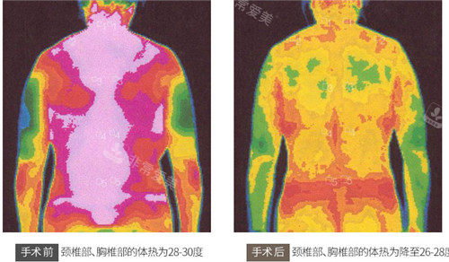 缩小手术手术体热变化