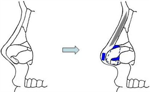 朝天鼻矫正过程图