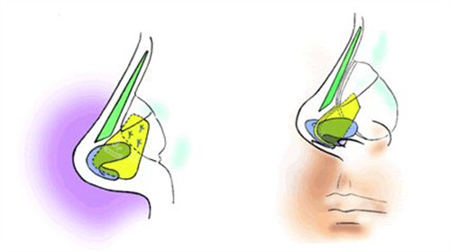朝天鼻矯正手術(shù)示意圖