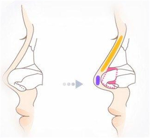 朝天鼻矯正手術(shù)示范圖