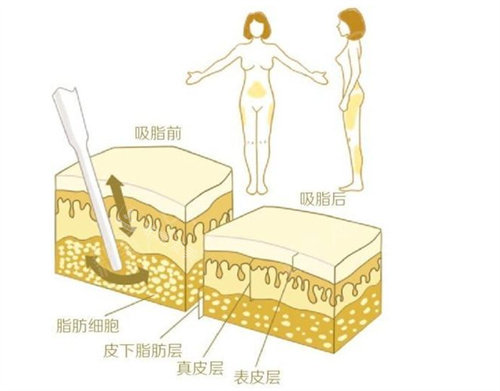 全身抽脂前后對(duì)比圖