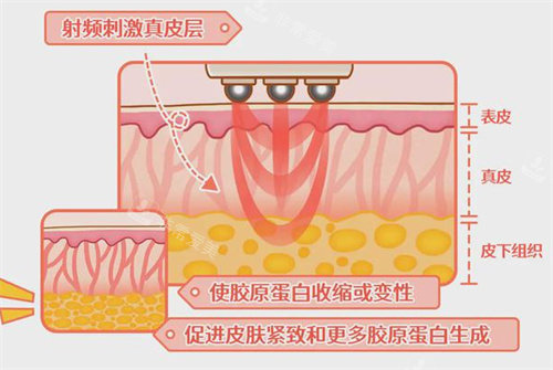 熱瑪吉操作前后皮膚變化圖 熱瑪吉操作前后皮膚變化圖