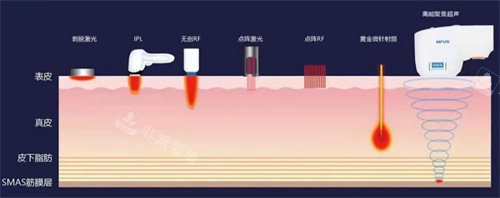 超聲炮操作原理圖 超聲炮操作原理圖