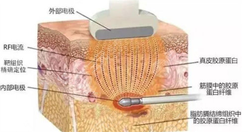 去皱手术图 去皱手术图
