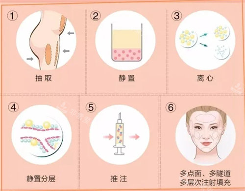 脂肪填充流程圖 脂肪填充流程圖