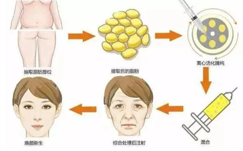 自體脂肪豐面頰流程圖 自體脂肪豐面頰流程圖