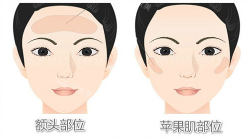 額頭和蘋果肌脂肪填充動(dòng)畫圖 額頭和蘋果肌脂肪填充動(dòng)畫圖