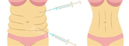 腰腹吸脂前后对比图 腰腹吸脂前后对比图
