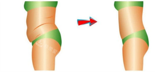 吸脂瘦腰腹动画图 吸脂瘦腰腹动画图