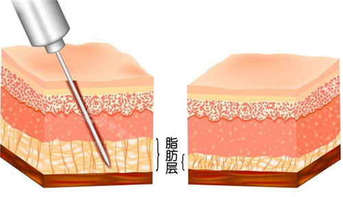 抽脂前后脂肪层变化图 抽脂前后脂肪层变化图
