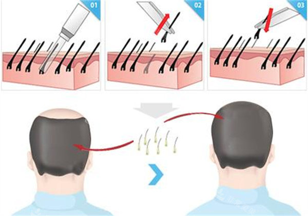 取毛囊方法图