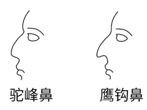 駝峰鼻和鷹鉤鼻對比圖 駝峰鼻和鷹鉤鼻對比圖