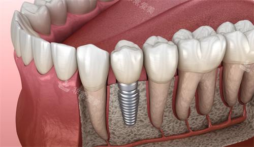 单颗种植牙示意图