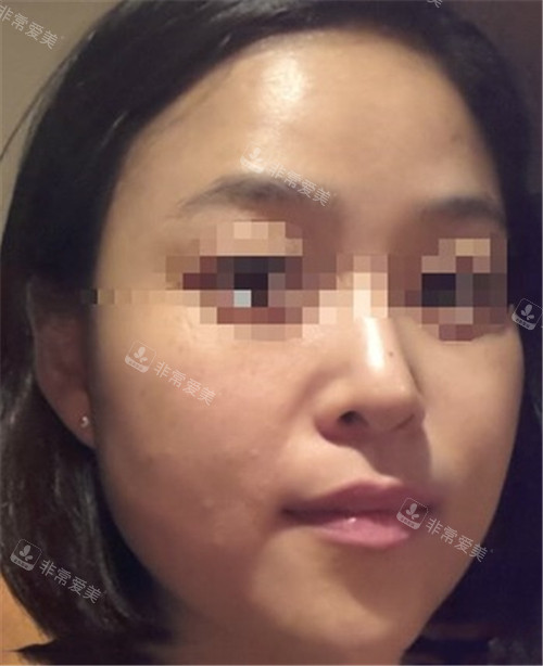 韓國美爾韓方醫(yī)院埋線提升術(shù)前圖 韓國美爾韓方醫(yī)院埋線提升術(shù)前圖
