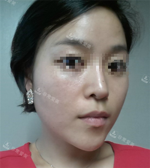 韓國美爾韓方醫(yī)院埋線提升術(shù)后圖 韓國美爾韓方醫(yī)院埋線提升術(shù)后圖