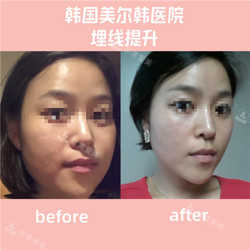 韓國美爾韓方醫(yī)院埋線提升對比照 韓國美爾韓方醫(yī)院埋線提升對比照