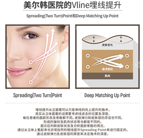 韓國美爾韓方醫(yī)院埋線提升術(shù)介紹 韓國美爾韓方醫(yī)院埋線提升術(shù)介紹
