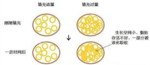 脂肪填充四年了熬夜都不吸收，揭晓脂肪填充不吸收的秘诀