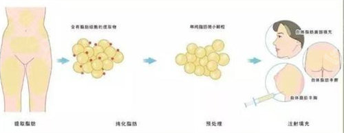 脂肪填充手术操作示意图