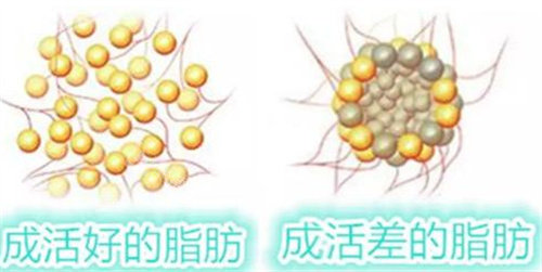 脂肪填充四年了熬夜都不吸收，揭晓脂肪填充不吸收的秘诀