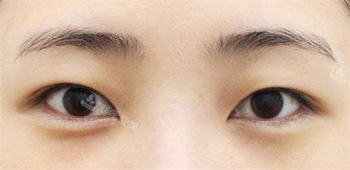 韓國AND整形外科雙眼皮術(shù)前圖