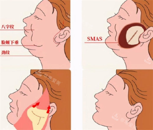 拉皮手术流程展示图