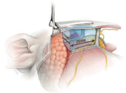 拉皮手术剥离范围展示图