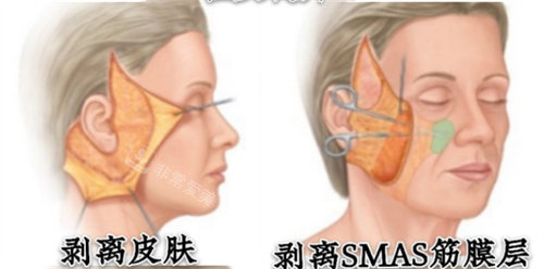 smas筋膜層剝離動(dòng)畫圖