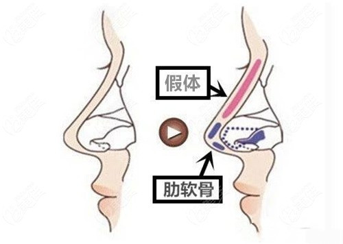 假體、肋軟骨手術(shù)示意圖 假體、肋軟骨手術(shù)示意圖