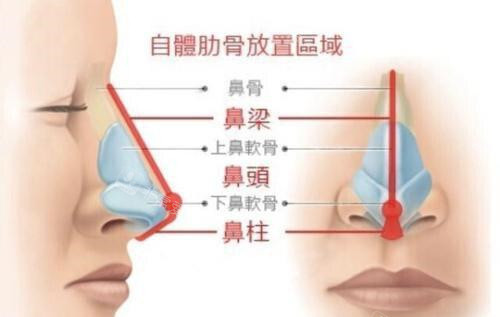 自体肋骨放置区域示意图