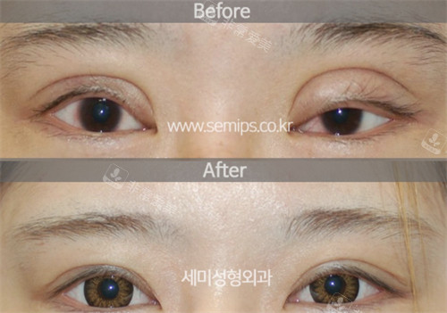 韓國世美整形眼修復(fù)前后圖 韓國世美整形眼修復(fù)前后圖